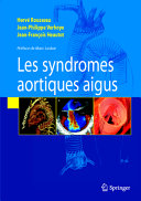 Les syndromes aortiques aigus /