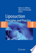 Liposuction : principles and practice /