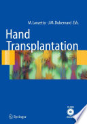 Hand transplantation /