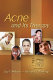 Acne and its therapy /