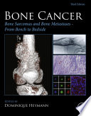 Bone cancer : bone sarcomas and bone metastases - from bench to bedside /