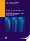 Revision of loose femoral prostheses : with a stem system based on the "press-fit" principle : a concept and a system of implants, a method and its results /
